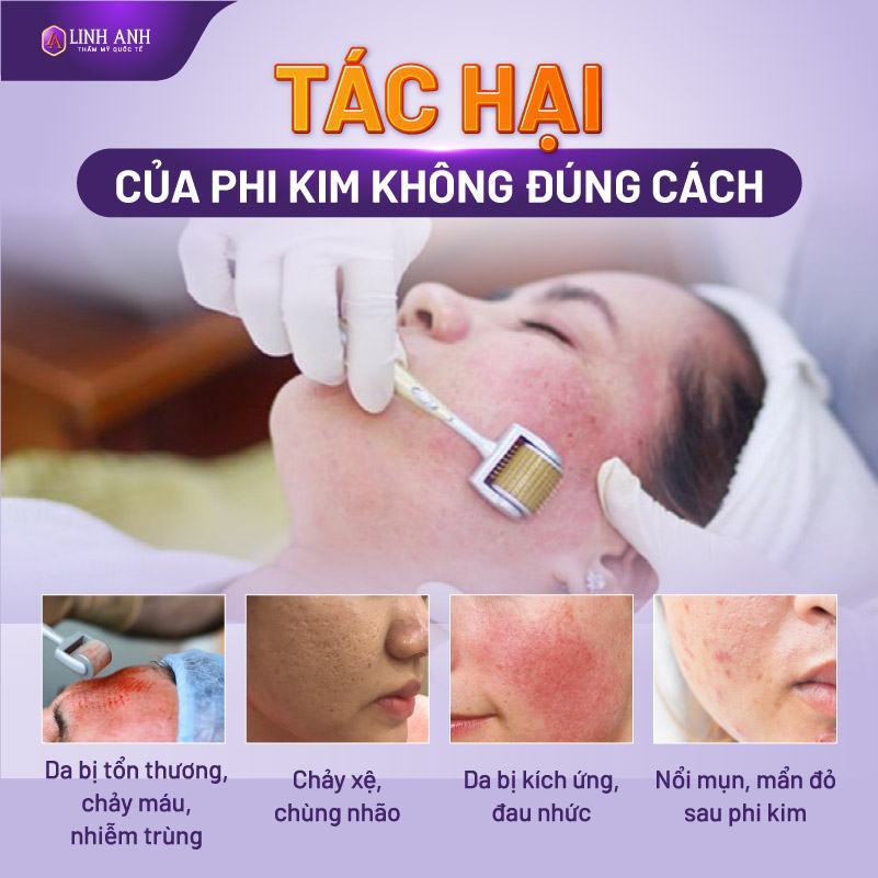 phi kim trị nám giá bao nhiêu - Viện thẩm mỹ Quốc tế Linh Anh phi kim trị nám có tốt không