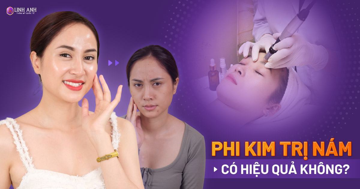 Phi kim trị nám là gì? Phi kim trị nám có tốt không?