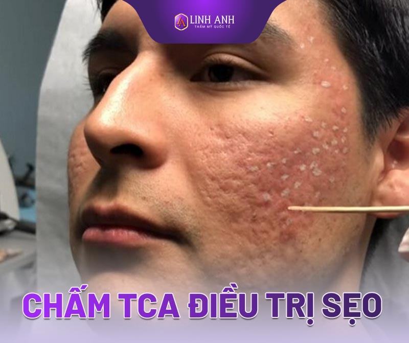 sẹo rỗ lâu năm - Thẩm mỹ Quốc tế Linh Anh sẹo rỗ lâu năm có điều trị được không