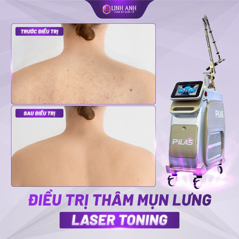 trị thâm mụn lưng tại nhà phương pháp trị thâm mụn lưng