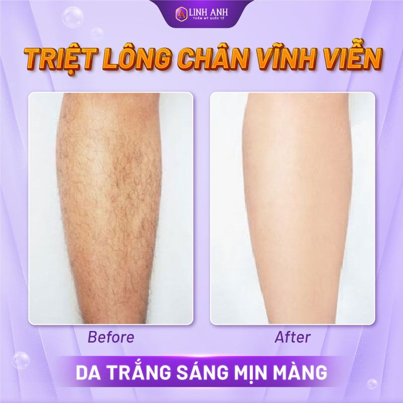 phương pháp triệt lông chân vĩnh viễn tại nhà