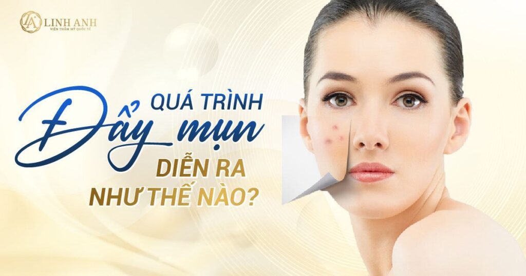 quá trình đẩy mụn diễn ra như thế nào - Viện thẩm mỹ quốc tế Linh Anh