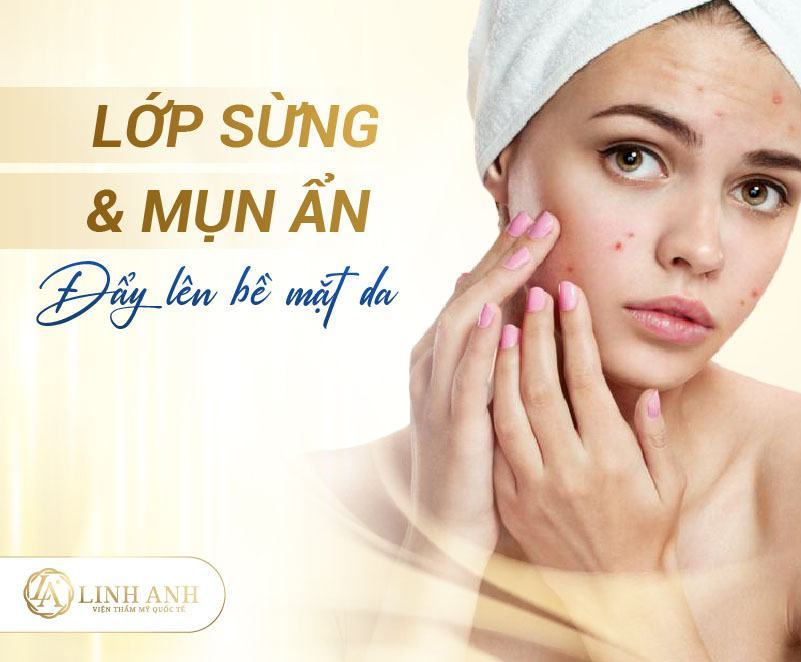 quá trình đẩy mụn diễn ra như thế nào quy trình đẩy mụn diễn ra như thế nào - Viện thẩm mỹ quốc tế Linh Anh
