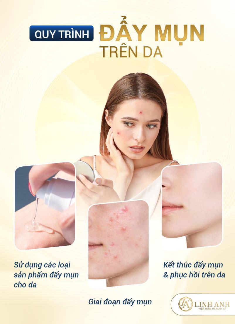 đẩy mụn dưới da diễn ra như thế nào quy trình đẩy mụn dưới da diễn ra làm sao - Viện thẩm mỹ quốc tế Linh Anhquy trình đẩy mụn dưới da diễn ra làm sao - Viện thẩm mỹ quốc tế Linh Anh