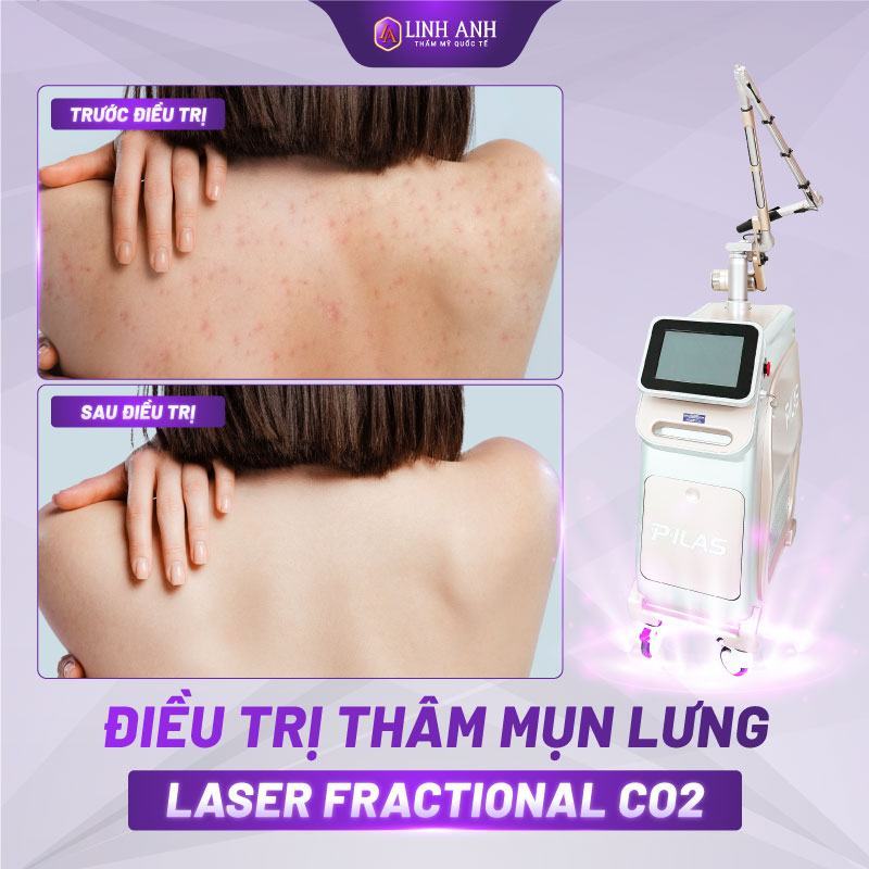 trị mụn thâm lưng review trị thâm mụn lưng