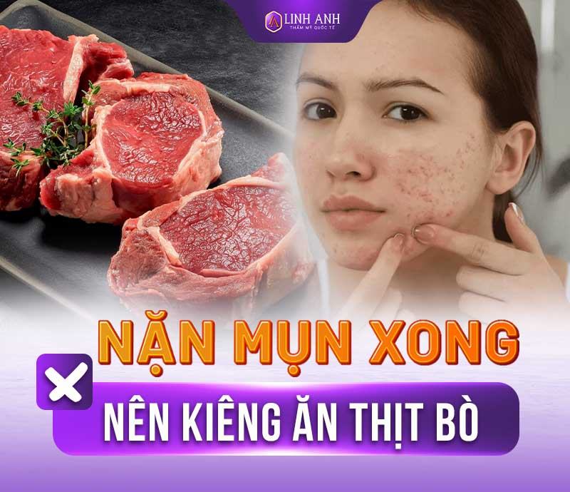 nặn mụn kiêng ăn gì sau khi nặn mụn nên ăn gì