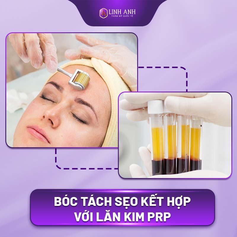 cách trị sẹo rỗ sẹo rỗ là gì