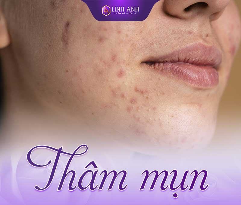 serum trị mụn