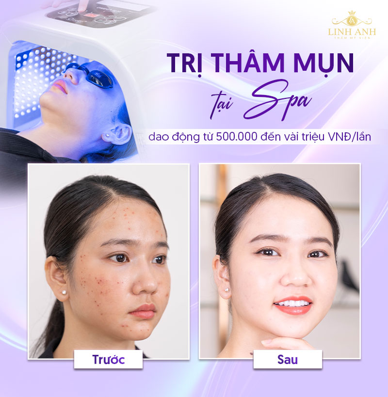 spa trị thâm mụn spa trị thâm mụn