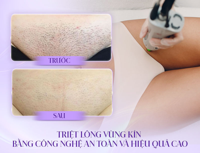 tác hại của triệt lông vùng kín không đúng cách tác hại của triệt lông vùng kín không đúng cách