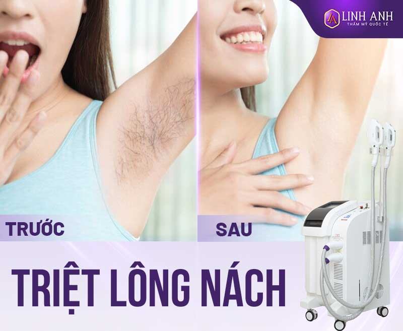tại sao triệt lông nách lại bị hôi nách - Thẩm mỹ Quốc tế Linh Anh tại sao sau khi triệt lông nách lại bị mùi hôi ở nách
