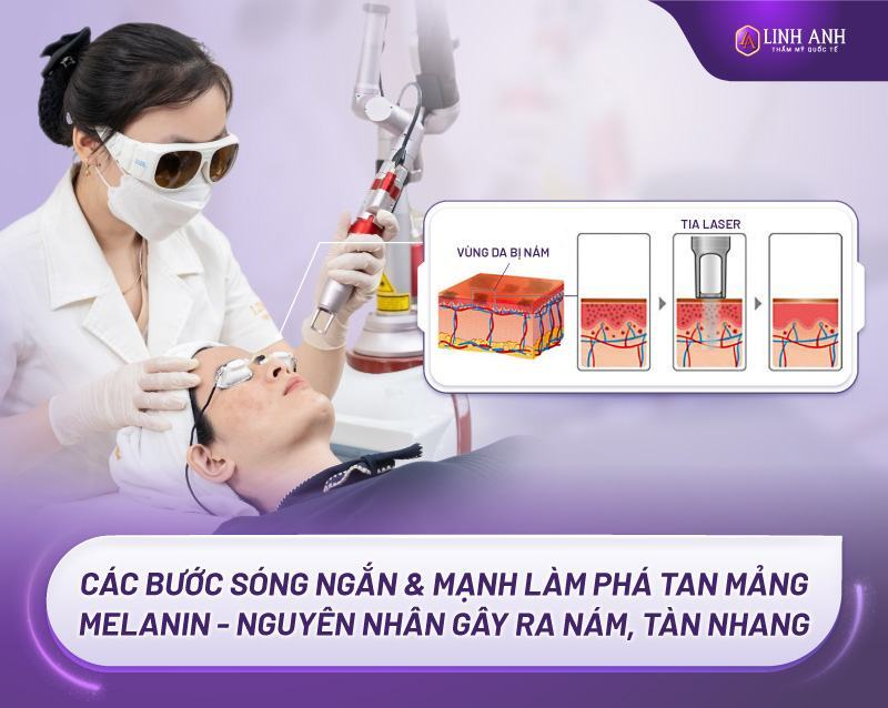 tàn nhang bẩm sinh có chữa được không tàn nhang bẩm sinh là gì