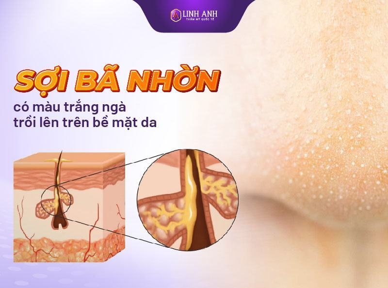 nhận biết các loại mụn tất cả các loại mụn