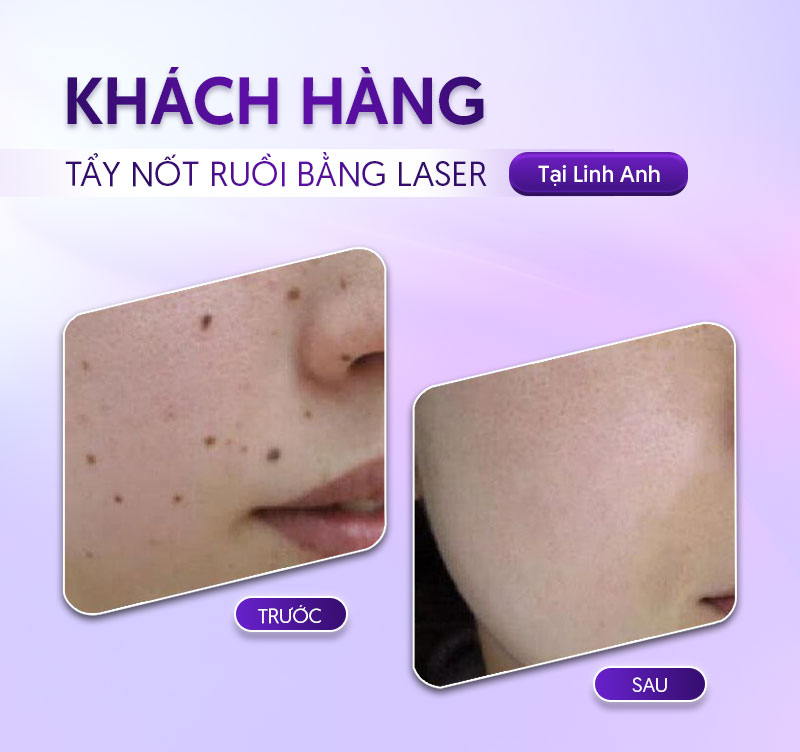 tẩy nốt ruồi bao nhiêu tiền 1 nốt tẩy nốt ruồi bao nhiêu tiền 1 nốt