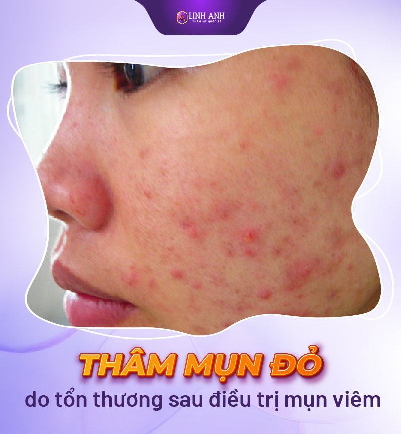 thâm đỏ sau mụn thâm đỏ sau mụn