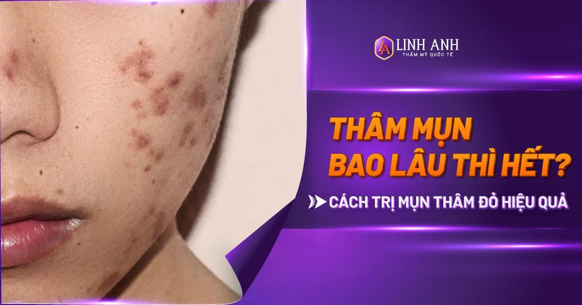 thâm mụn bao lâu thì hết