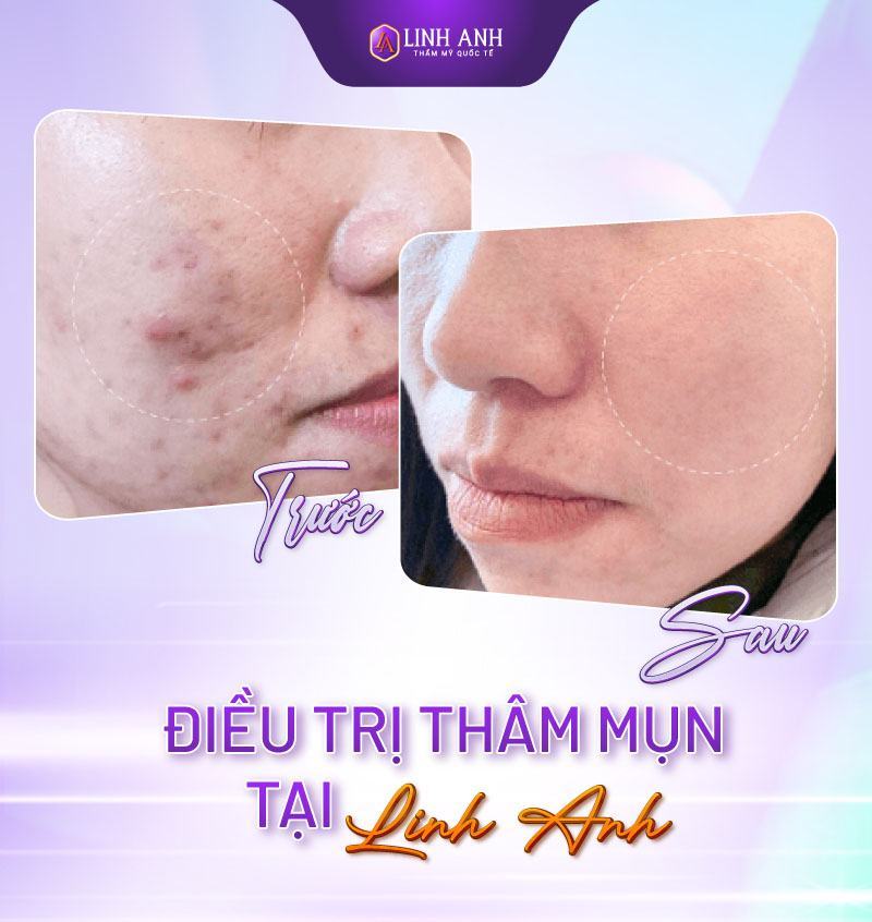 vết thâm mụn bao lâu thì hết thâm mụn có tự hết không