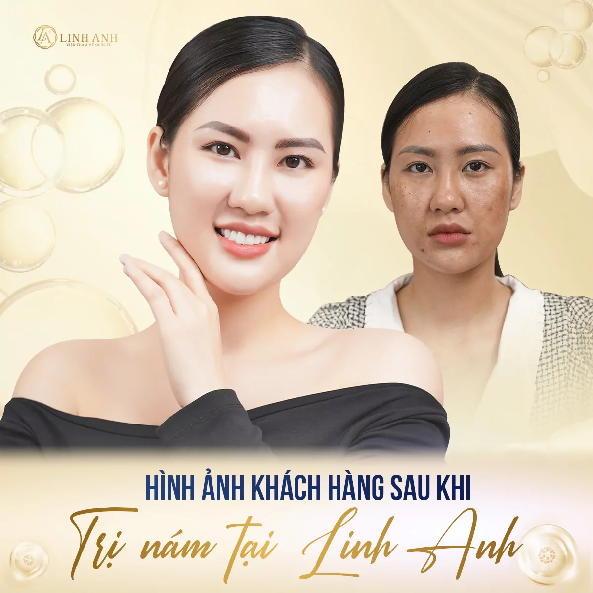 thành phần trị nám hữu hiệu - Viện thẩm mỹ quốc tế Linh Anh