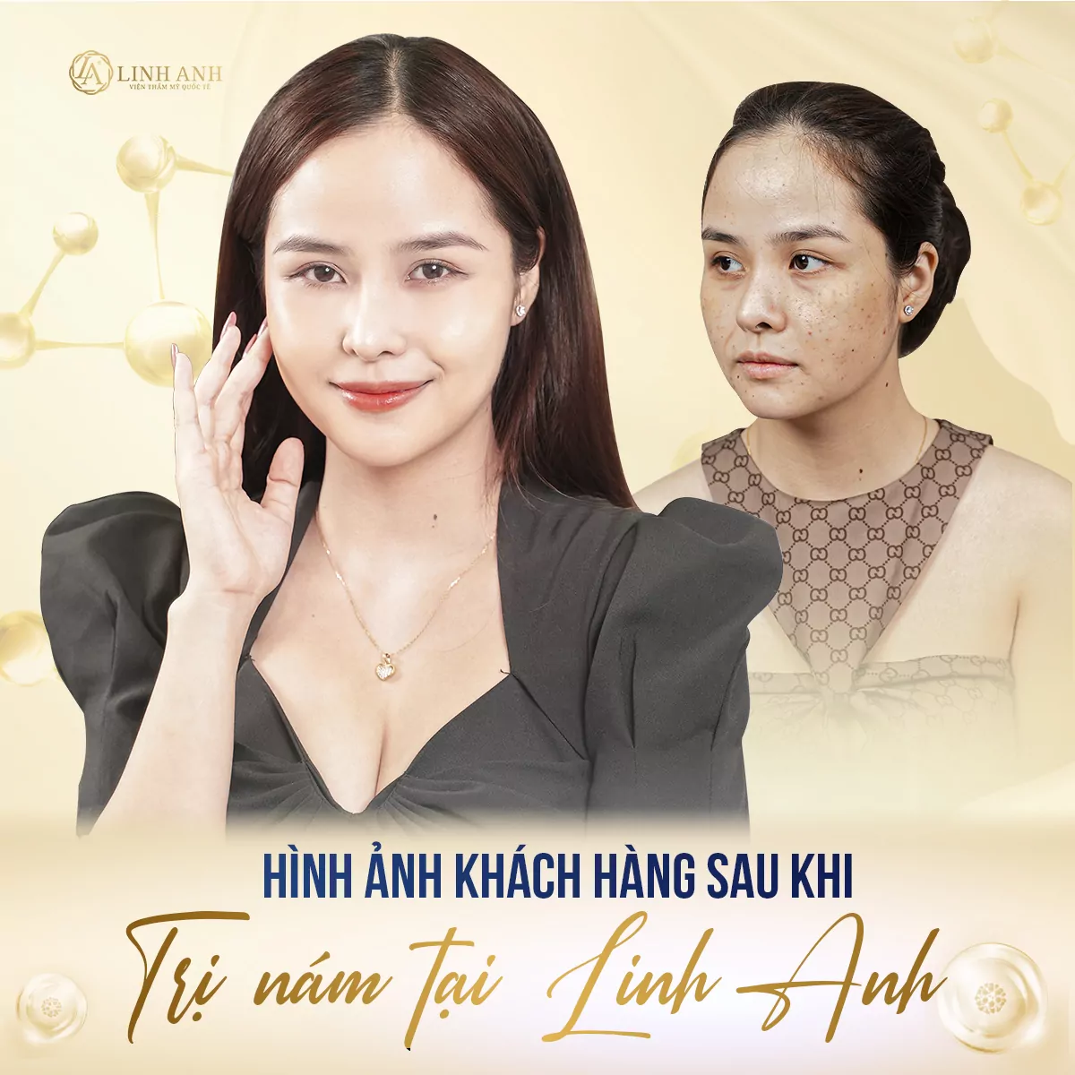thành phần trị nám ở da - Viện thẩm mỹ quốc tế Linh Anh