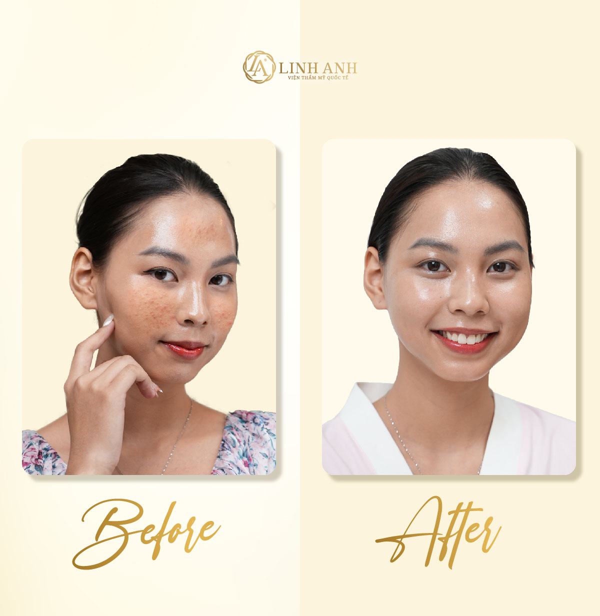thức khuya bị nổi mụn thức khuya bị nổi mụn - Viện thẩm mỹ quốc tế Linh Anh