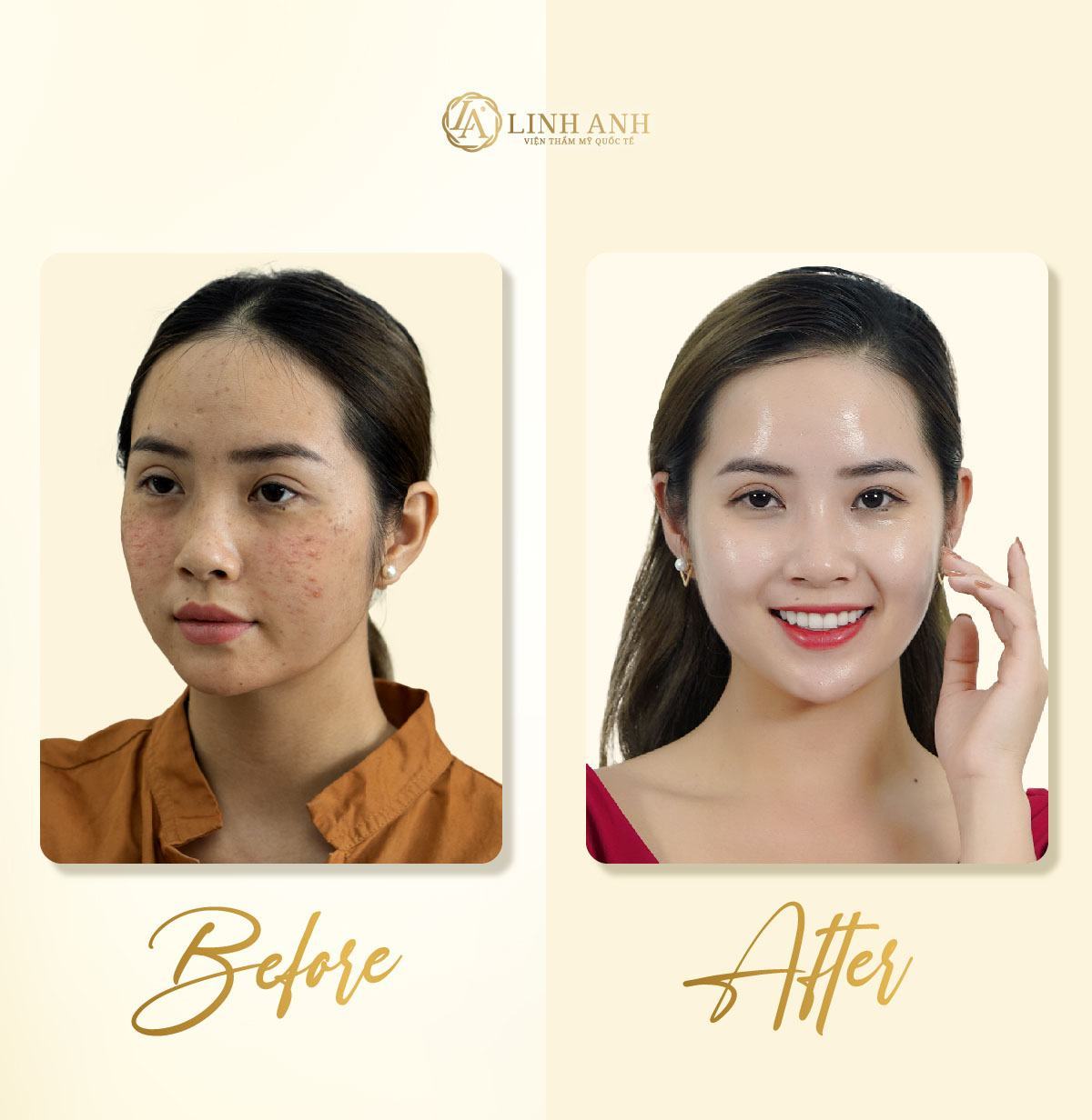 thức khuya có bị nổi mụn hay không thức khuya có nổi mụn hay không - Viện thẩm mỹ quốc tế Linh Anh