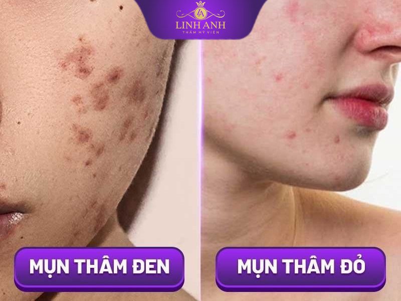 thuốc trị thâm mụn thuốc trị thâm mụn cấp tốc