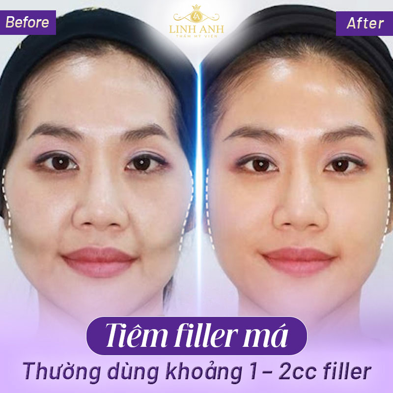 tiêm má hóp bao nhiêu cc Tiêm má baby bao nhiêu cc là đủ