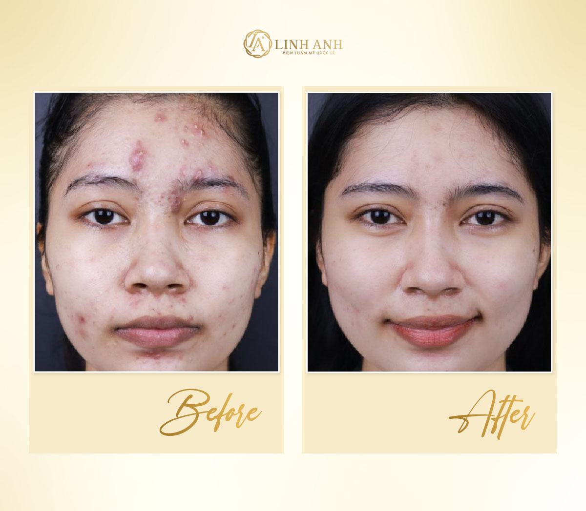 tinh trùng trị mụn được không tinh trùng có trị mụn được không - Viện thẩm mỹ quốc tế Linh Anh