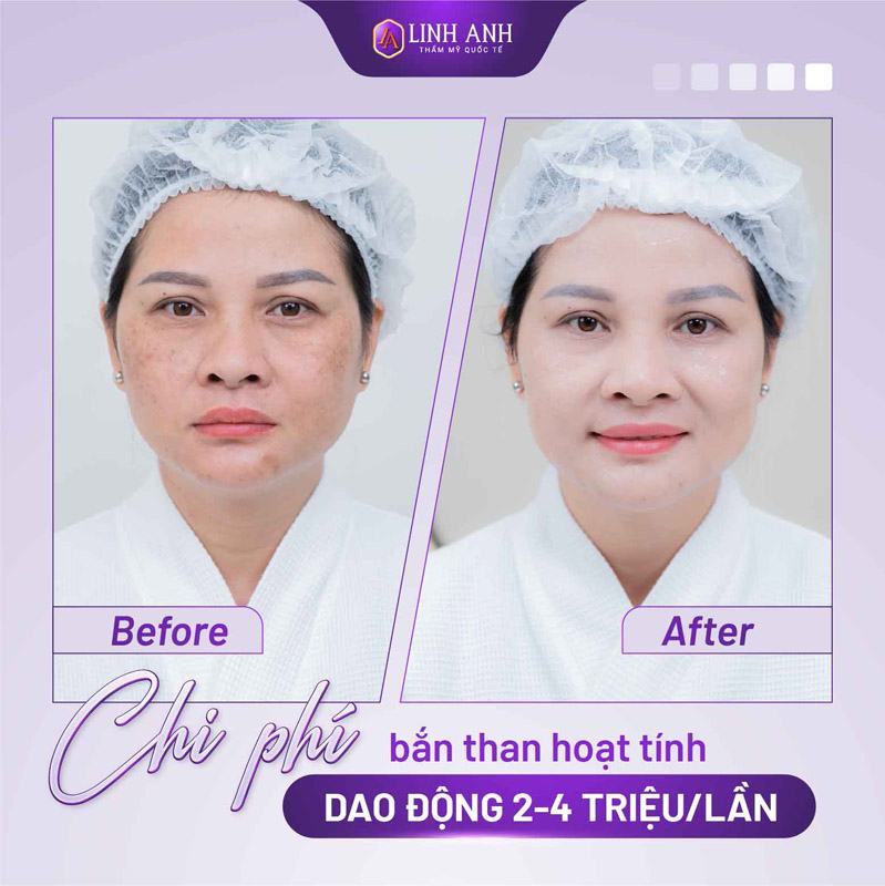 trẻ hoá làn da bằng than hoạt tính trẻ hóa da laser carbon