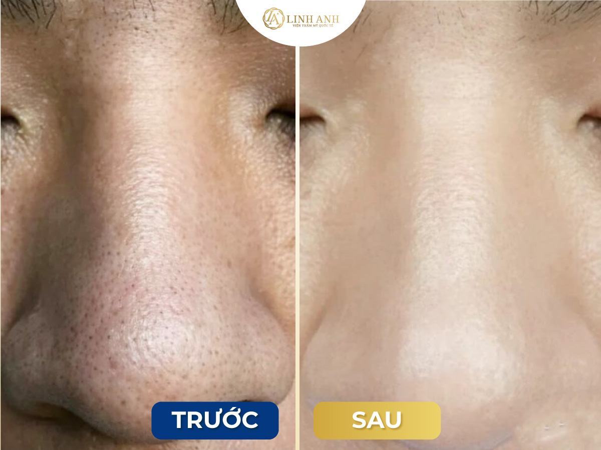 trị cho da mụn đầu đen và lỗ chân lông to - Viện thẩm mỹ quốc tế Linh Anh trị cho da mụn đầu đen và lỗ chân lông to - Viện thẩm mỹ quốc tế Linh Anh