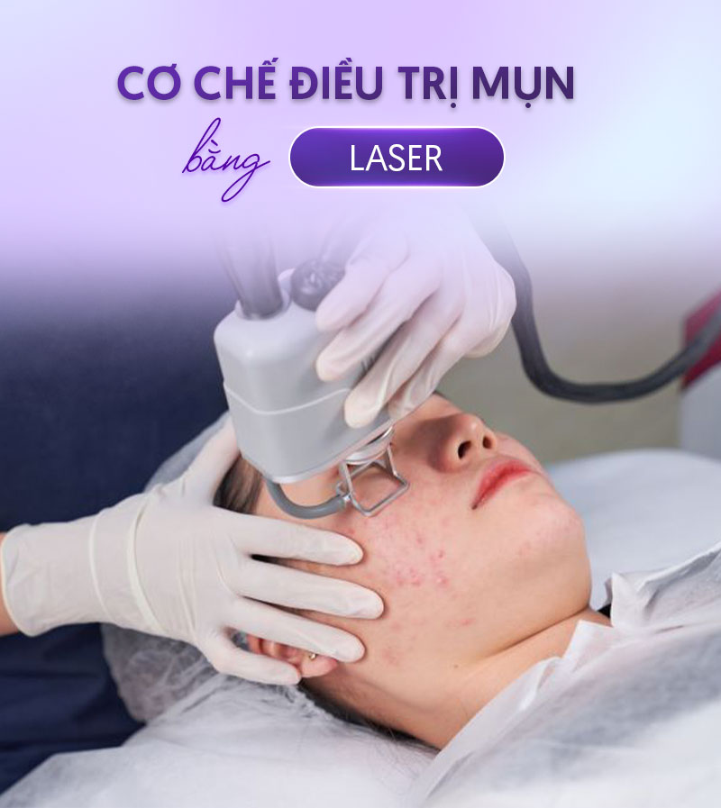 trị mụn bằng laser giá bao nhiêu trị mụn bằng laser giá bao nhiêu