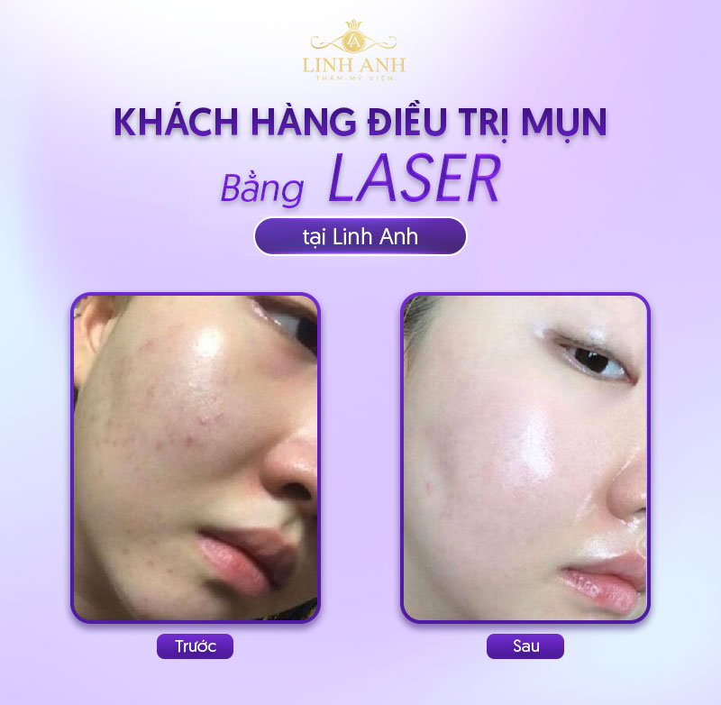 trị mụn bằng laser trị mụn bằng laser