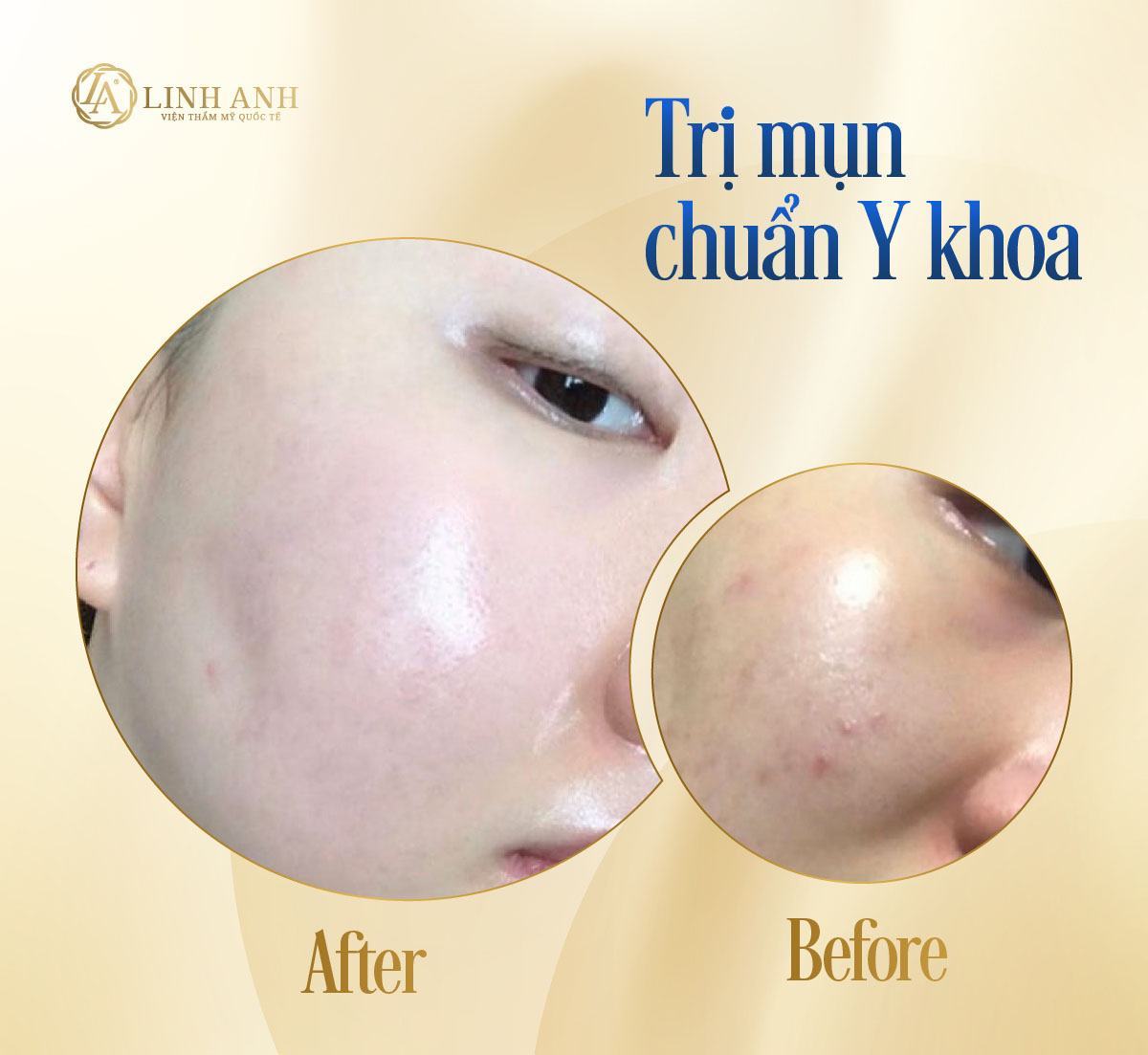 trị mụn đầu đen bằng vaseline hiệu quả trị mụn đầu đen bằng vaseline hiệu quả - Viện thẩm mỹ quốc tế Linh Anh