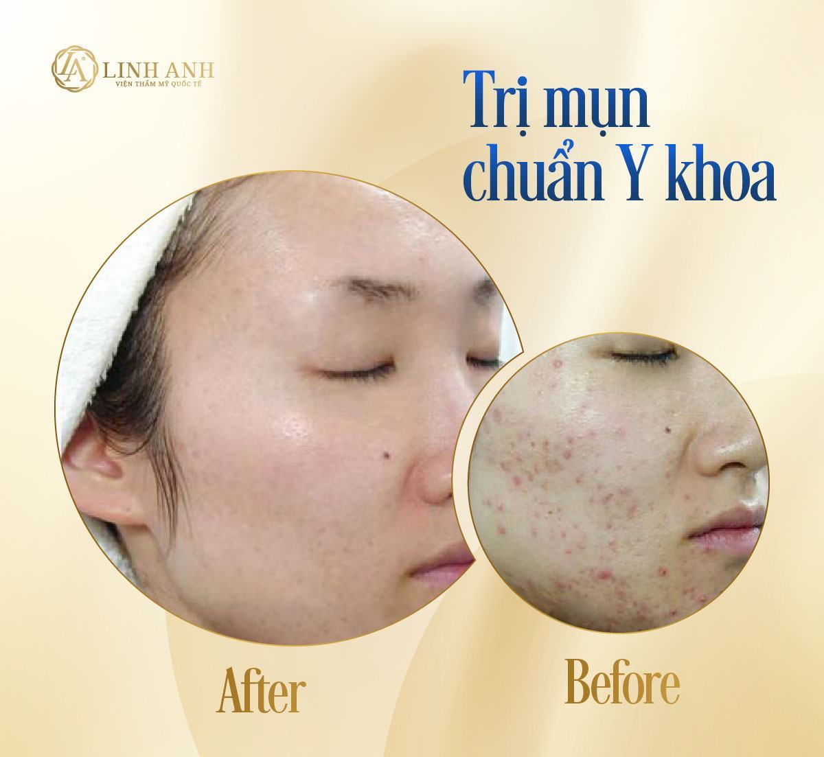 phương pháp trị mụn đầu đen với vaseline trị mụn đầu đen với vaseline hiệu quả - Viện thẩm mỹ quốc tế Linh Anh