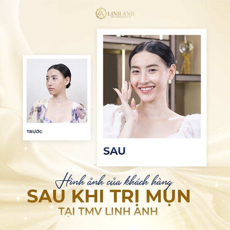 trị mụn li ti trên mặt - Viện thẩm mỹ quốc tế Linh Anh trị mụn li ti trên mặt - Viện thẩm mỹ quốc tế Linh Anh