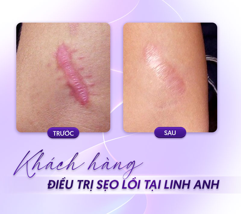 trị sẹo lồi bv da liễu bao nhiêu trị sẹo lồi bv da liễu bao nhiêu