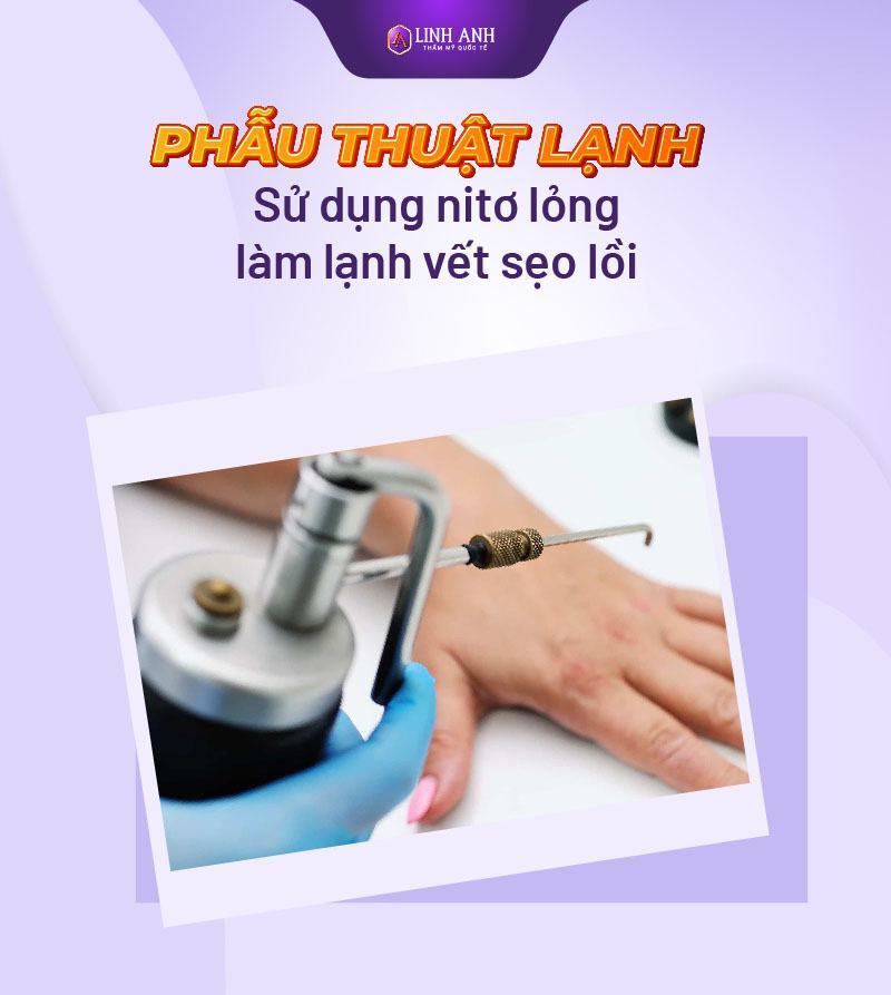 trị sẹo lồi ở đâu tốt trị sẹo lồi lâu năm