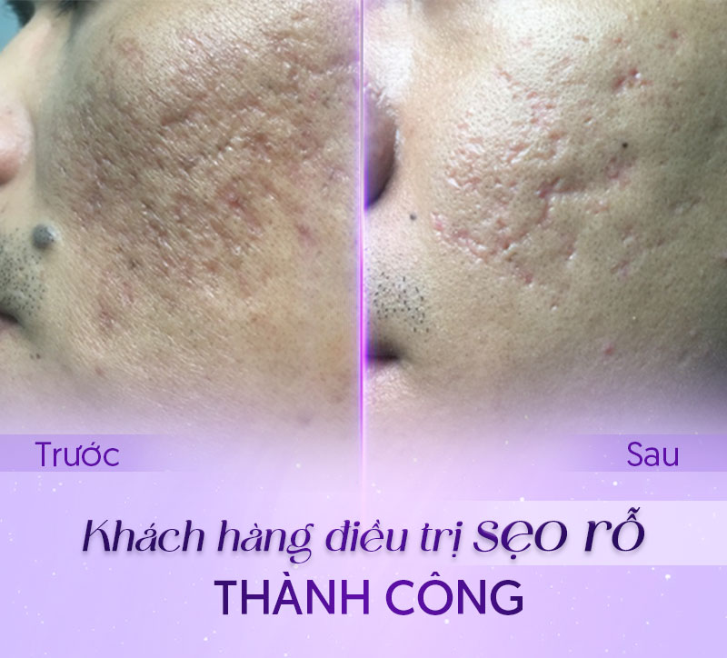 trị sẹo rỗ giá bao nhiêu trị sẹo rỗ giá bao nhiêu