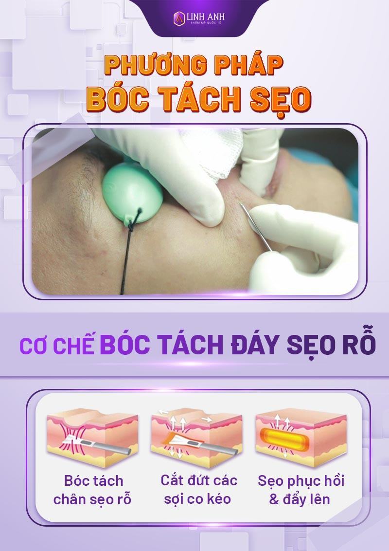 sẹo rỗ lâu năm - Thẩm mỹ Quốc tế Linh Anh trị sẹo rỗ lâu năm