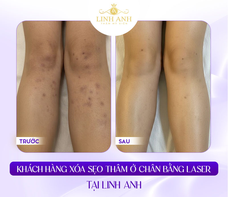 Trị sẹo thâm ở chân nhanh nhất