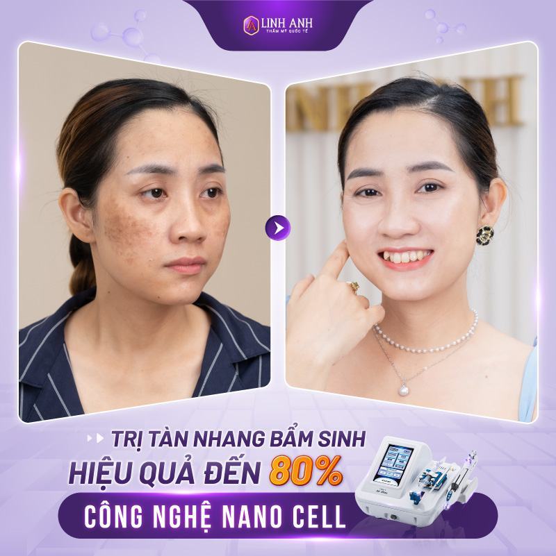 trị tàn nhang bẩm sinh trị tàn nhang bẩm sinh tại nhà