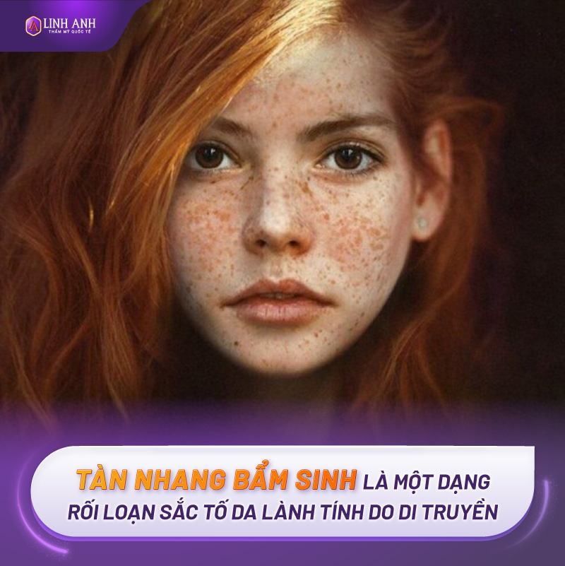 cách trị tàn nhang bẩm sinh trị tàn nhang bẩm sinh