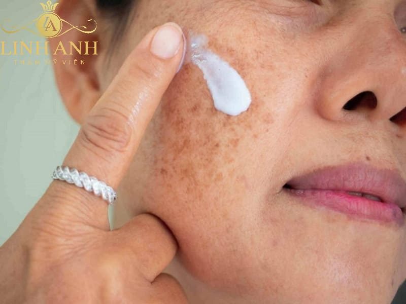cách trị tàn nhang bằng kem đánh răng trị tàn nhang bằng kem đánh răng có hiệu quả không