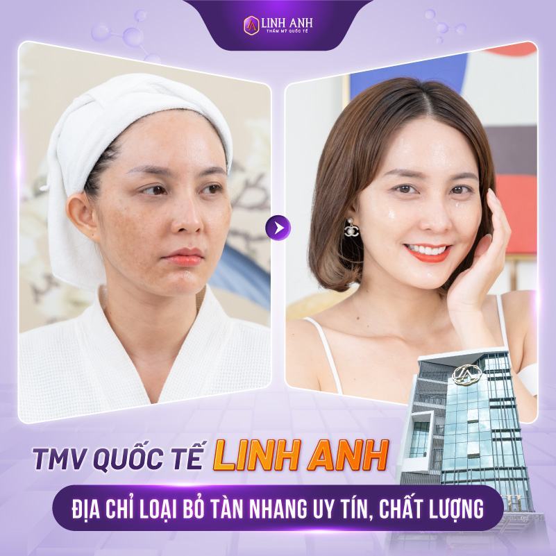 trị tàn nhang bằng mật ong hiệu quả