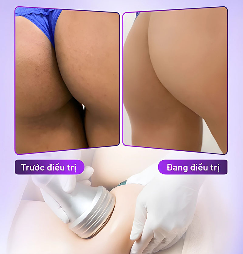 trị thâm mông bằng laser trị thâm mông bằng laser