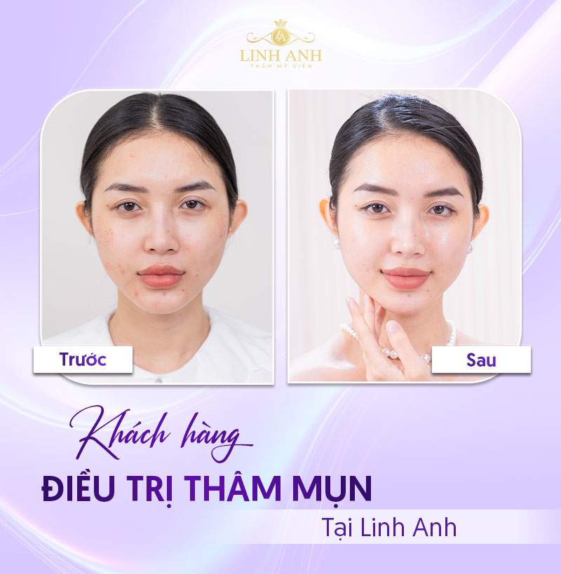 trị thâm mụn tại spa trị thâm mụn tại spa