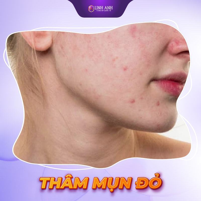 cách trị mụn thâm đỏ trị thâm mụn đỏ
