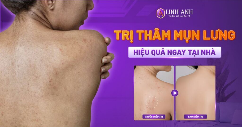 trị thâm mụn lưng