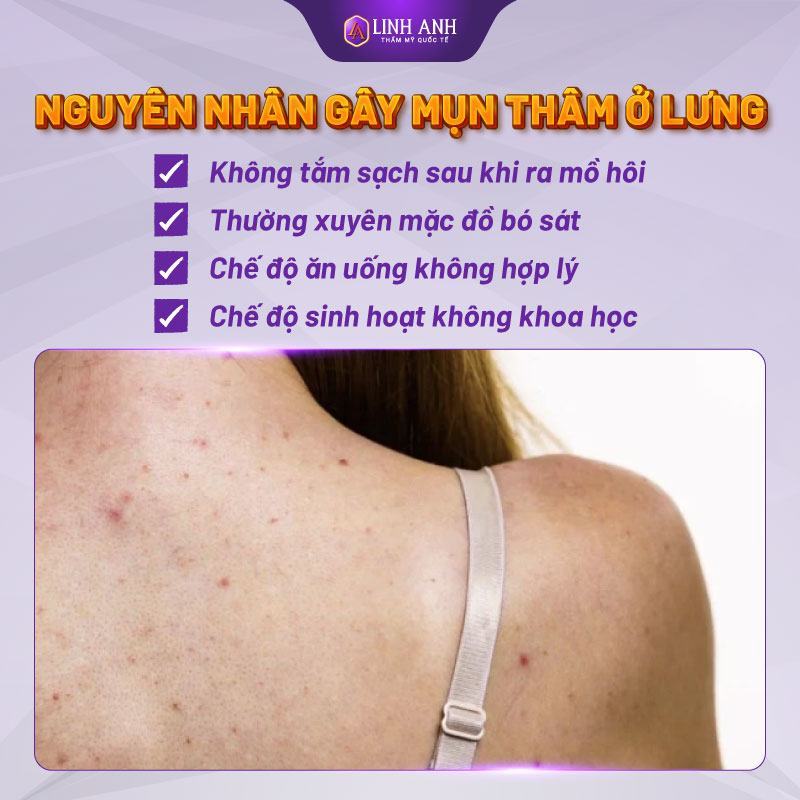 trị thâm mụn lưng trị thâm mụn lưng lâu năm