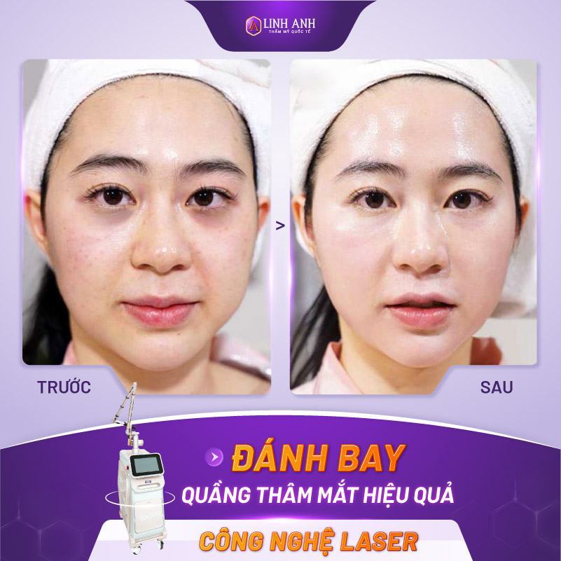 trị thâm quầng mắt bẩm sinh